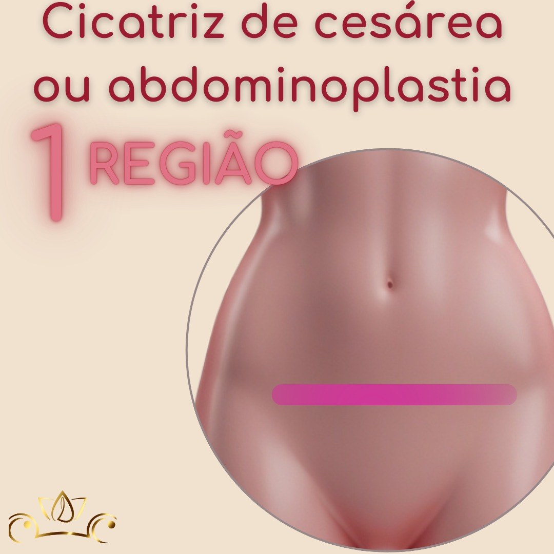 Método Liftam | Clareamento íntimo